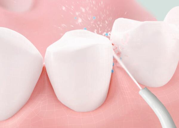 洗牙后用洗牙器好還是電動牙刷？口腔清潔工具這樣選！